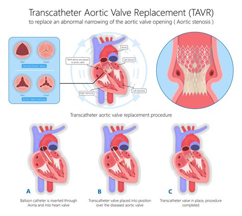 miv miv|aortic valve replacement procedure.